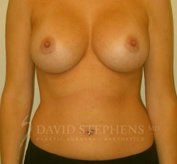 Breast-Augmentation-Patient-62 | After Breast