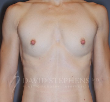 Breast-Augmentation-Patient-71 | Before Breast