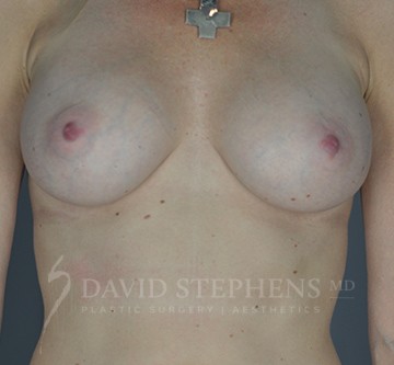 Breast-Augmentation-Patient-53 | After Breast