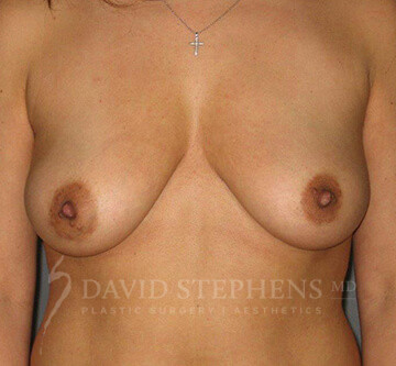 Breast-Augmentation-Mastopexy-Patient-11 | Before Breast Augmentation w/Lift