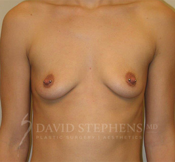 Breast-Augmentation-Mastopexy-Patient-12 | Before Breast Augmentation w/Lift