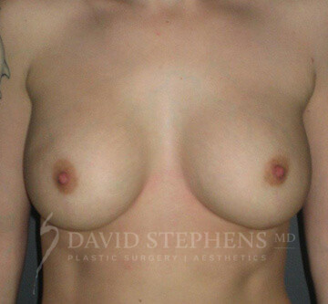 Breast-Augmentation-Mastopexy-Patient-14 | After Breast Augmentation w/Lift