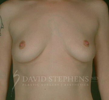 Breast-Augmentation-Mastopexy-Patient-14 | Before Breast Augmentation w/Lift