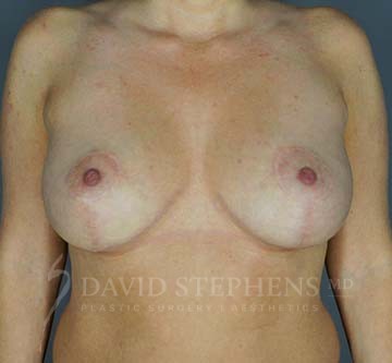 Breast-Augmentation-Mastopexy-Patient-18 | After Breast Augmentation w/Lift