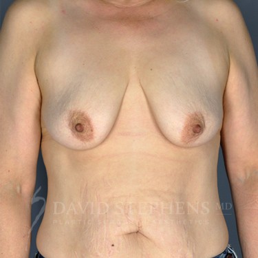Breast-Augmentation-Mastopexy-Patient-19 | Before Breast Augmentation w/Lift