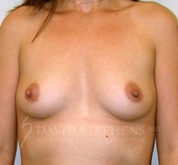 Breast-Augmentation-Patient-01 | Before Breast Augmentation
