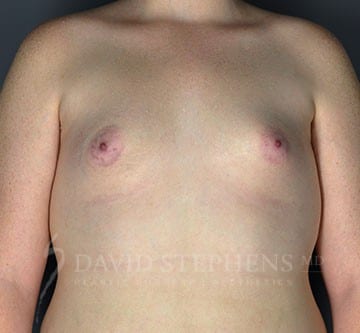 Breast-Augmentation-Patient-03 | Before Breast Augmentation
