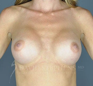 Breast-Augmentation-Patient-05 | After Breast Augmentation
