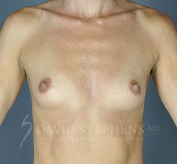 Breast-Augmentation-Patient-05 | Before Breast Augmentation