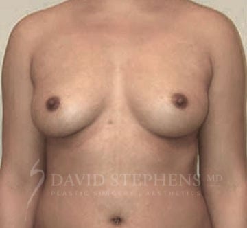 Breast-Augmentation-Patient-08 | Before Breast Augmentation