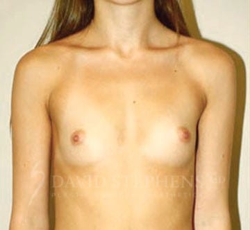 Breast-Augmentation-Patient-09 | Before Breast Augmentation
