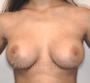 Breast-Augmentation-Patient-10 | After Breast Augmentation