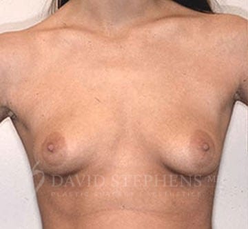 Breast-Augmentation-Patient-10 | Before Breast Augmentation