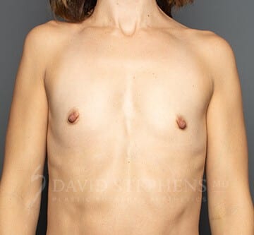 Breast-Augmentation-Patient-21 | Before Breast Augmentation