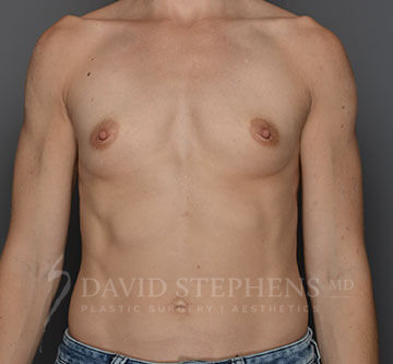 Breast-Augmentation-Patient-27 | Before Breast Augmentation
