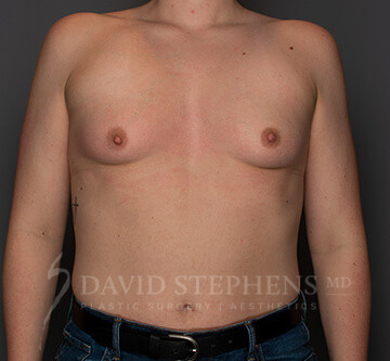 Breast Augmentation Special Offer - Actual Patient Results - Before - 2