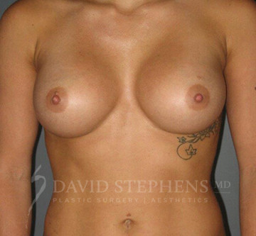 Breast-Augmentation-Patient-38 | After Breast Augmentation