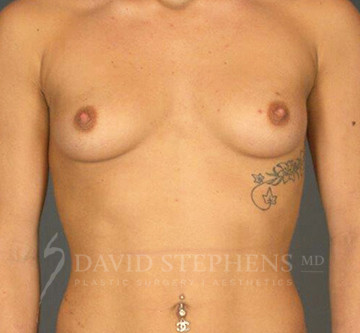 Breast-Augmentation-Patient-38 | Before Breast Augmentation