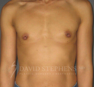 Breast-Augmentation-Patient-39 | Before Breast Augmentation