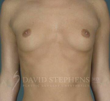 Breast-Augmentation-Patient-40 | Before Breast Augmentation