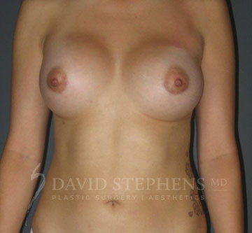 Breast-Augmentation-Patient-41 | After Breast Augmentation