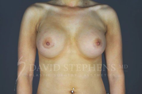 Breast-Augmentation-Patient-43 | After Breast Augmentation