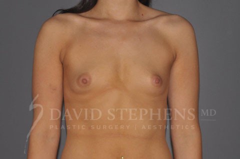 Breast-Augmentation-Patient-43 | Before Breast Augmentation