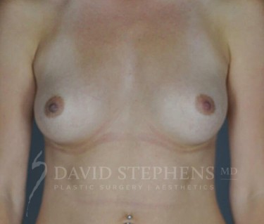 Breast-Augmentation-Patient-44 | Before Breast Augmentation