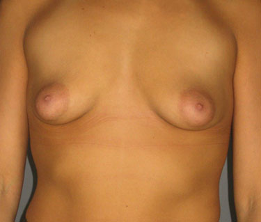 Breast-Augmentation-Patient-45 | Before Breast Augmentation