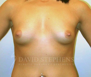 Breast-Augmentation-Patient-46 | Before Breast Augmentation
