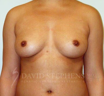Breast-Augmentation-Patient-51 | Before Breast Augmentation