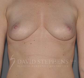 Breast-Augmentation-Patient-53 | Before Breast Augmentation