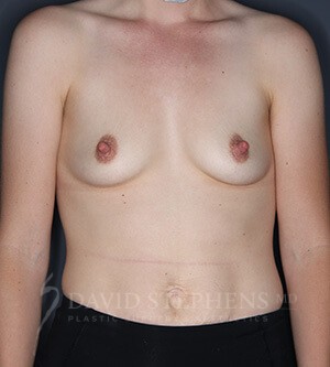 Breast-Augmentation-Patient-59 | Before Breast Augmentation