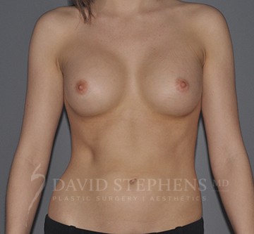Breast-Augmentation-Patient-60 | After Breast Augmentation