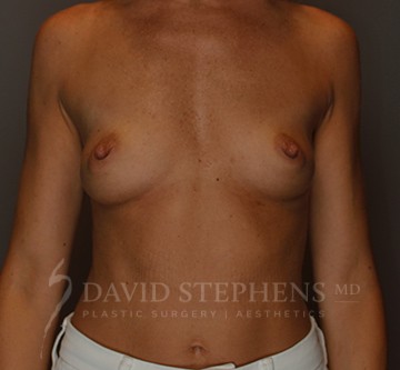 Breast-Augmentation-Patient-63 | Before Breast Augmentation
