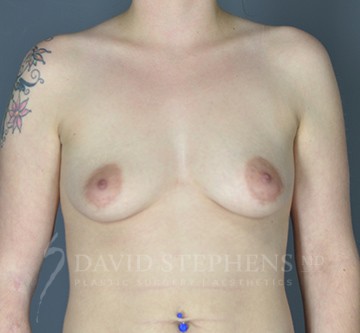 Breast-Augmentation-Patient-64 | Before Breast Augmentation