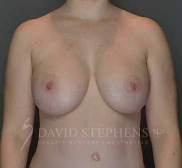 Breast-Augmentation-Patient-65 | After Breast Augmentation