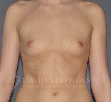 Breast-Augmentation-Patient-6 | Before Breast Augmentation