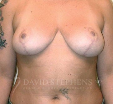Breast Lift - Actual Patient Results - After - 1