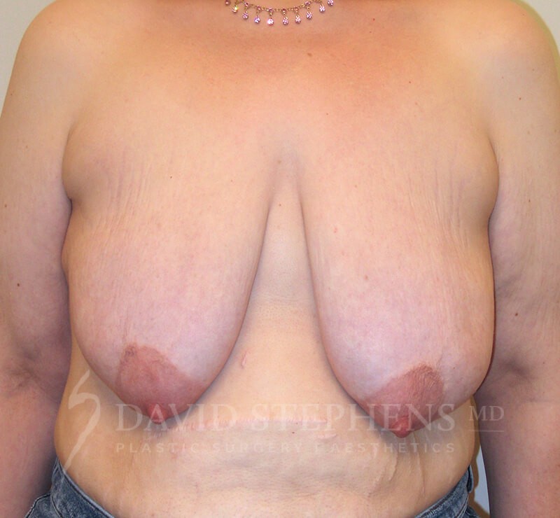 Breast Lift - Actual Patient Results - Before - 3
