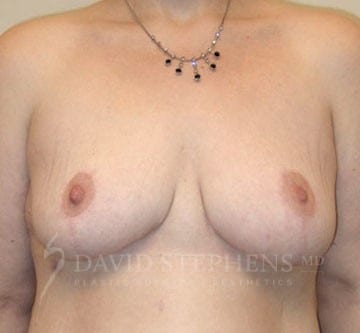 Breast-Reduction-Patient-01 | After Breast Reduction