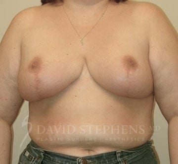 Breast-Reduction-Patient-02 | After Breast Reduction