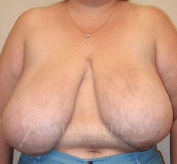 Breast-Reduction-Patient-02 | Before Breast Reduction