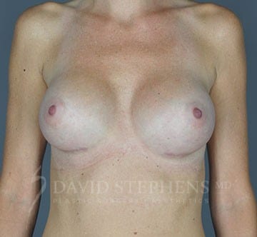 Breast-Revision-Patient-01 | After Breast Revision