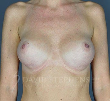 Breast-Revision-Patient-01 | Before Breast Revision