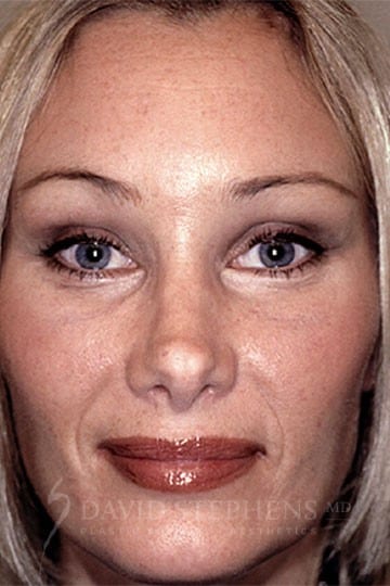 Browlift-Patient-01 | After Browlift