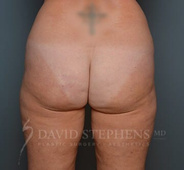 Cellfina-Patient-01 | After Cellfina