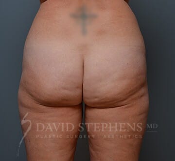 Cellfina-Patient-01 | Before Cellfina