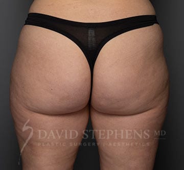 Cellfina-Patient-03 | After Cellfina