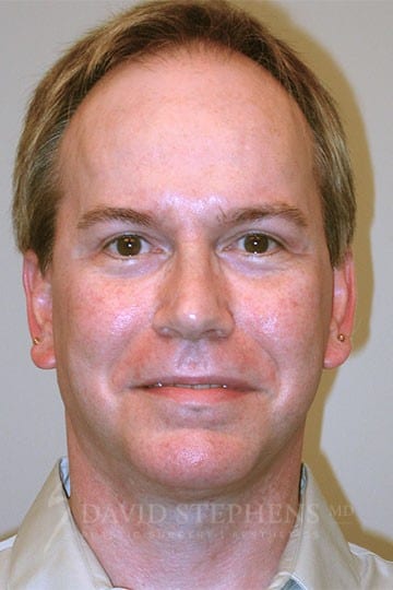 Cosmetic Surgery for Men - Actual Patient Results - After - 1